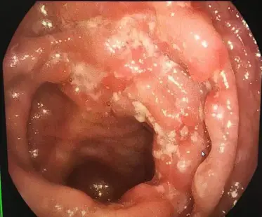 克罗恩病ct图片_罗克罗恩病_罗克恩病早期症状