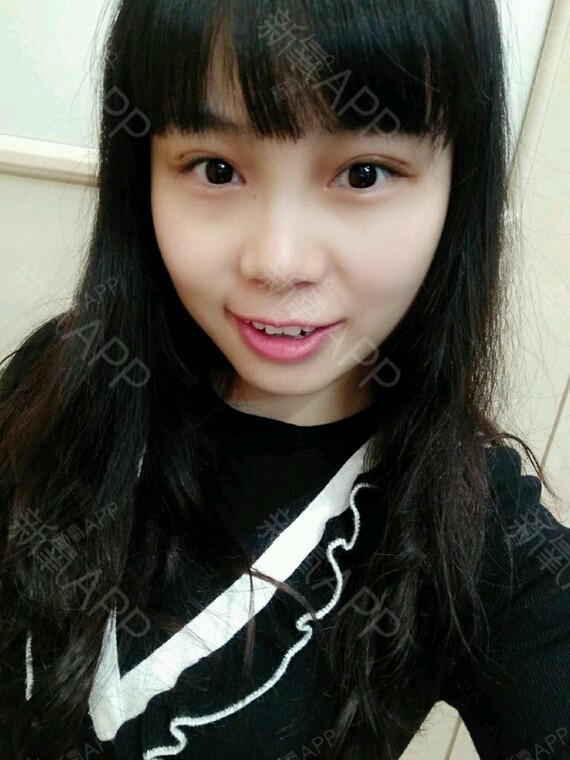 辽宁朝阳二院双眼皮_辽宁朝阳二医院割双眼皮_朝阳市二院双眼皮