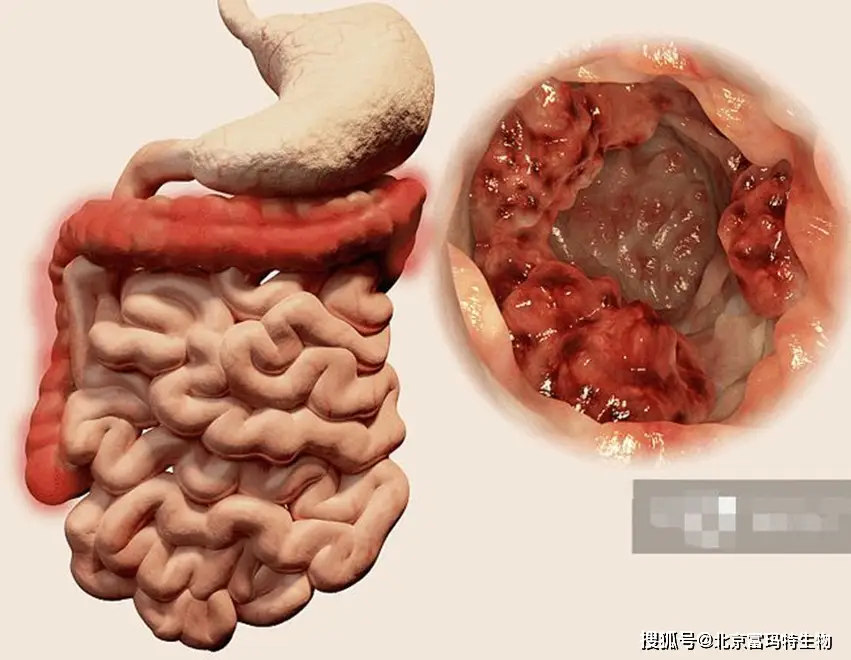 克罗恩病：慢性炎症性肠病的顽固小妖精，如何驯服它？