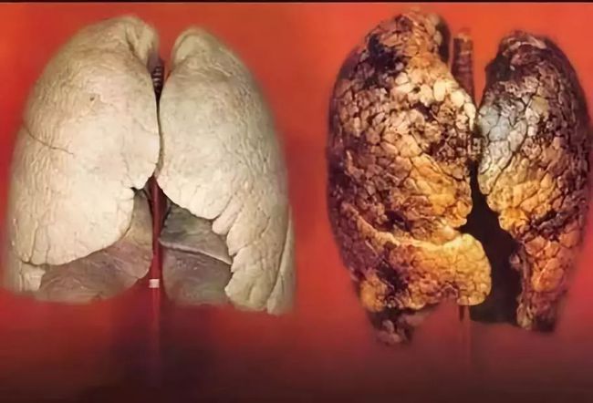 肺炎黄痰和白痰有什么区别_肺炎黄痰变白痰但是不好咳出_黄痰 白痰 肺炎