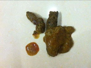 肛门疼大便出血是怎么回事_大便出血肛门疼是直肠癌吗_大便出血痛肛门疼痛