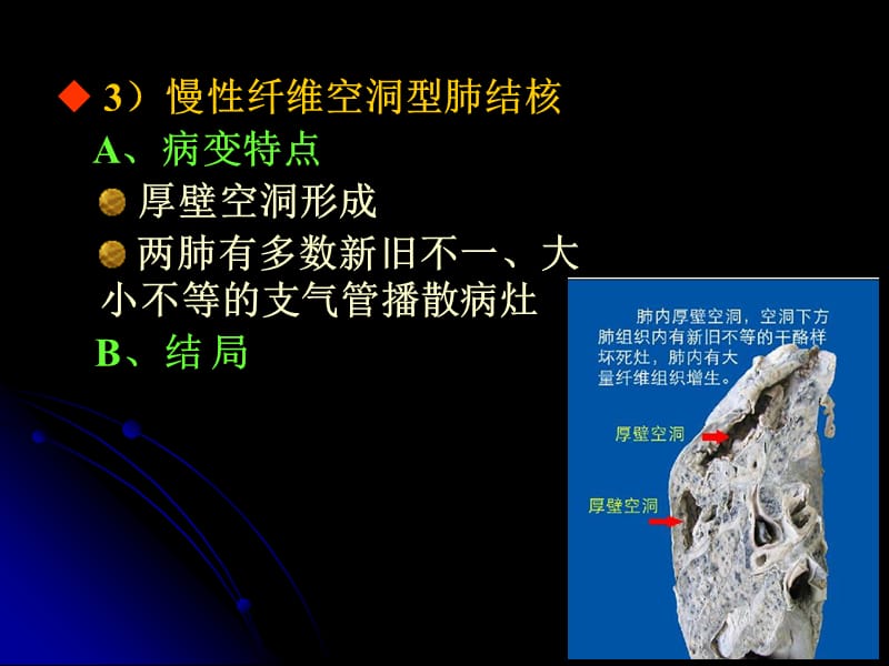 肺结核复发还有传染性吗_肺结核性继发复发会传染人吗_继发性肺结核会复发吗