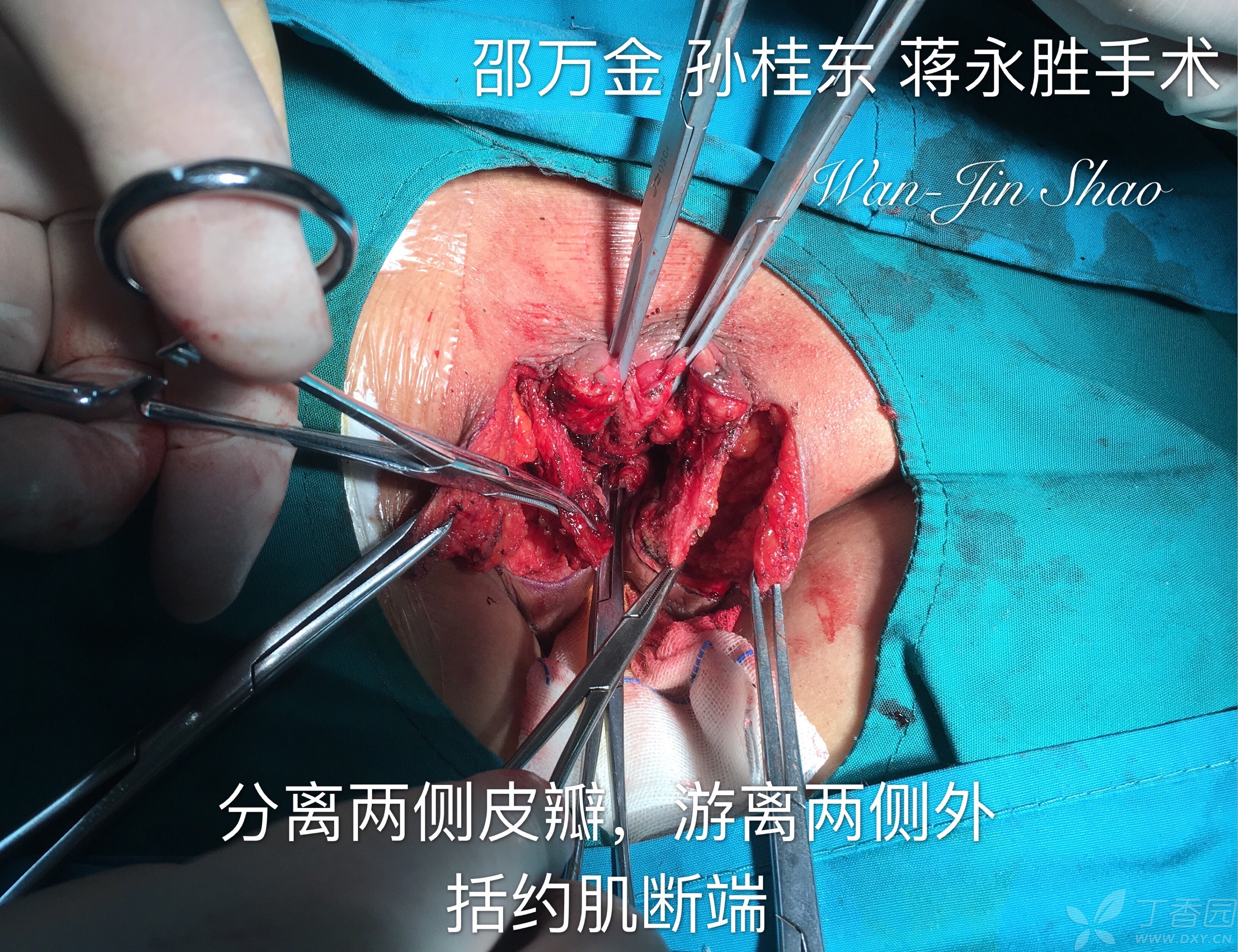 肛门失禁的治疗_肛门症状治疗失禁多久能好_肛门失禁的症状 治疗
