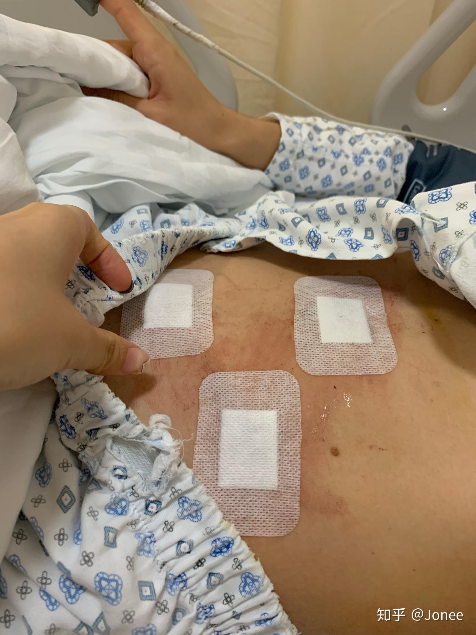 急性化脓性阑尾炎术后护理_急性化脓性阑尾炎术后护理_急性化脓性阑尾炎术后护理