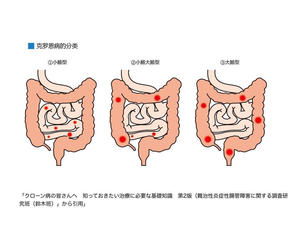 克罗恩病课件_克罗恩病ppt_克罗恩病ppt课件免费下载