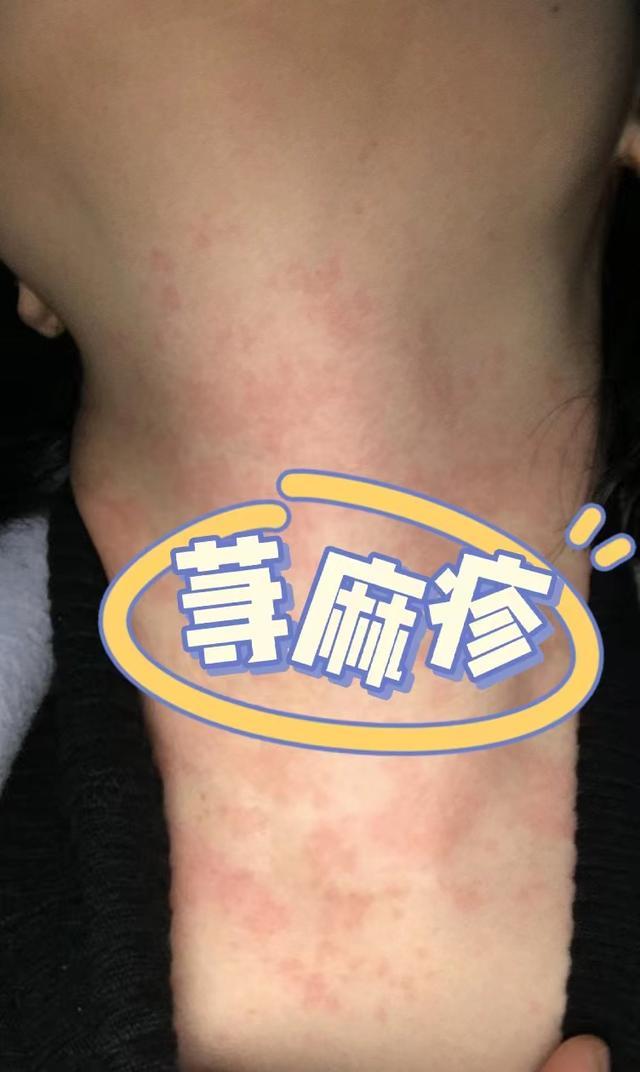 中医治疗荨麻疹的方子叫什么_中医治愈荨麻疹的经验介绍_中医治疗荨麻疹的原理