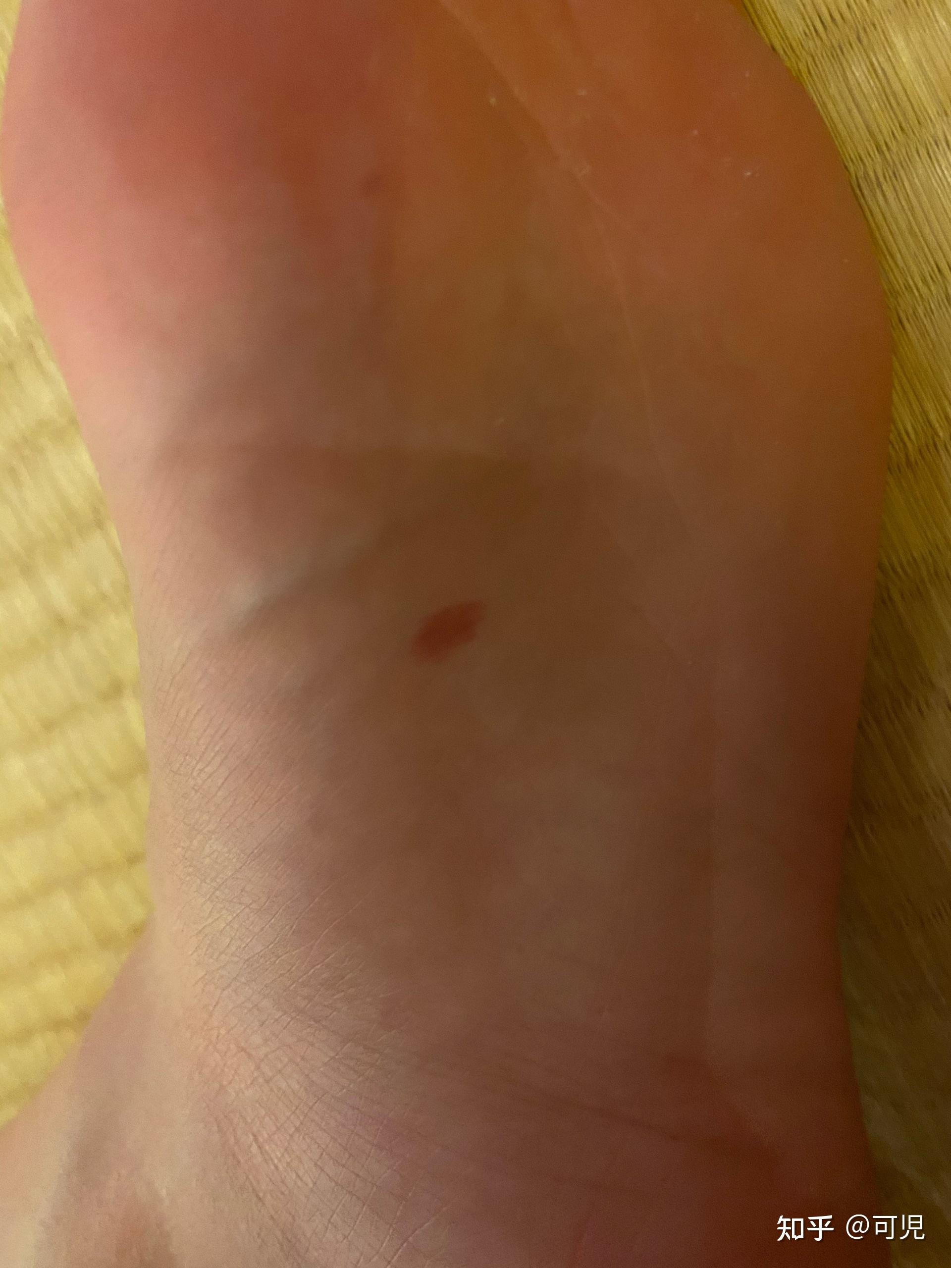 前胸后背疼有红痣_后背疼前胸红痣有什么影响_前胸后背都有红痣