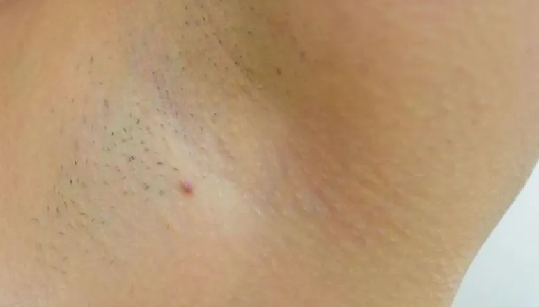 前胸后背疼有红痣_后背疼前胸红痣有什么影响_前胸后背都有红痣