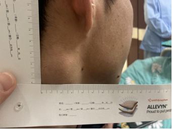 前胸后背疼有红痣_后背疼前胸红痣有什么影响_前胸后背都有红痣