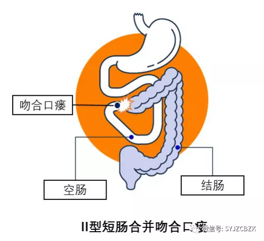克罗恩病规范诊断_克罗恩病鉴别诊断表格_诊断克罗恩的标准