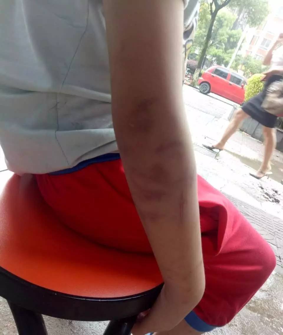 手臂红点出血_手臂上有很多小红点渗血_手臂上小红点出血点