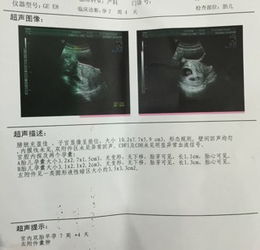 b超显示双肾系统分离,原因、症状及应对措施